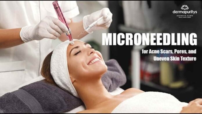 microneedling for acne scars, skin repair treatment, collagen therapy, dermatologist treatment